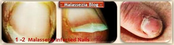 Infected Nails1 MB