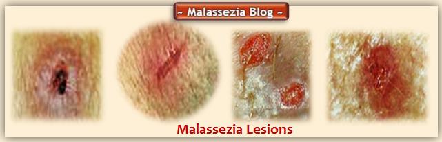 Malassezia Lesions 6  MB